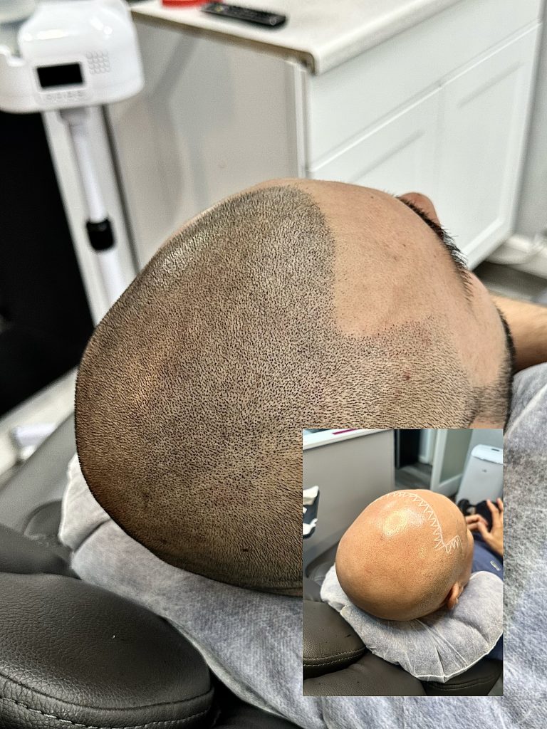 Scalp Micro Pigmentation