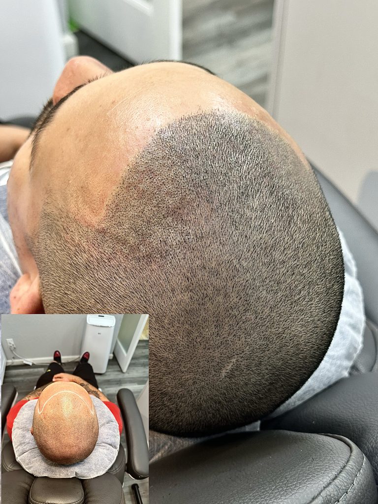 Scalp Micro Pigmentation