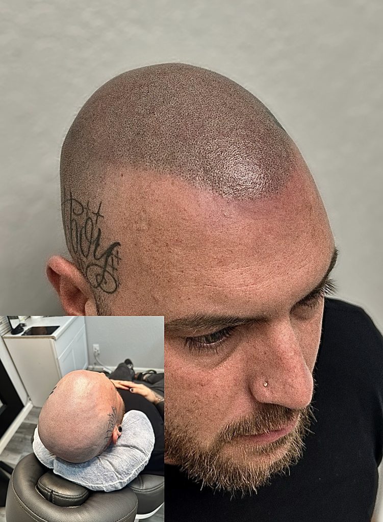 Scalp Micro Pigmentation